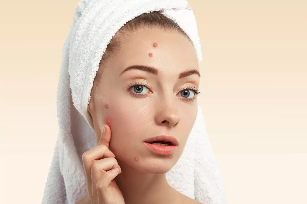 Acne Treatment